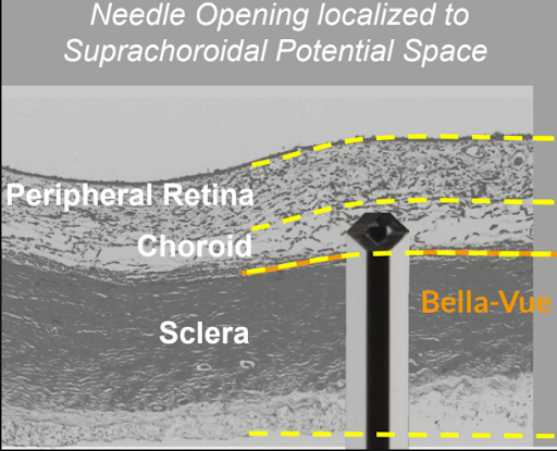 Needle Opening Location for Suprachorodial Needle Opening Localized for Suprachorodial Potential Space