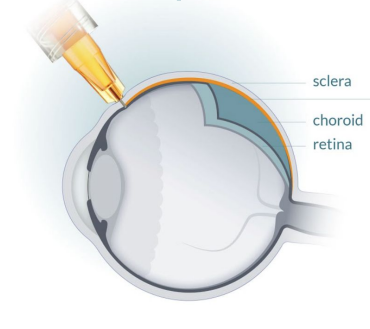 Superchorodial Administration Superchorodial Administration in Wet AMD Diagram