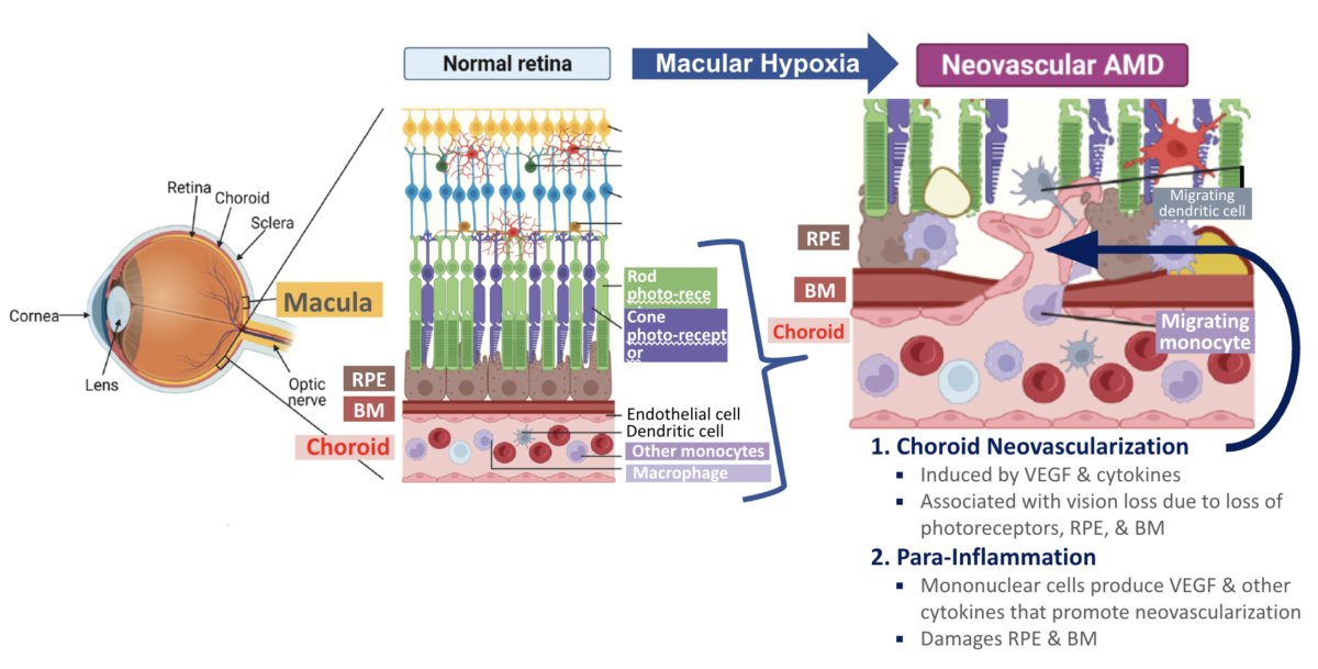 Wet AMD Chart Chart of How Wet AMD Evolves in the Aging Eye