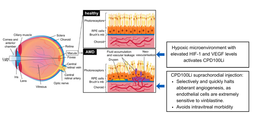 Wet AMD Homepage Chart showing AMD vs. healthy eye